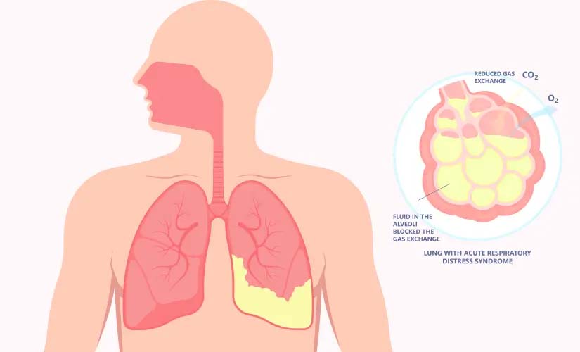 Acute_bronchitis-img