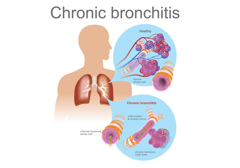 ChronicBronchitis