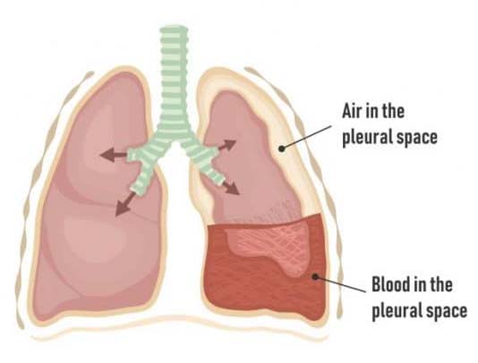 Haemothorax