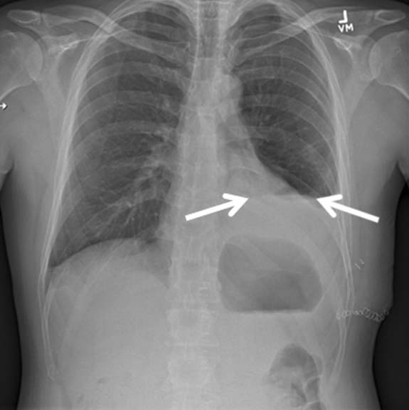 Hydro Pneumothorax
