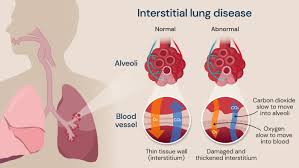 Interatial_lung_diseases