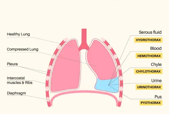 Pleural effusion