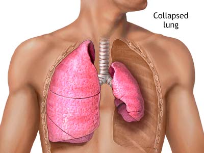 Pneumothorax