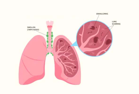 Sarcoidosis-img