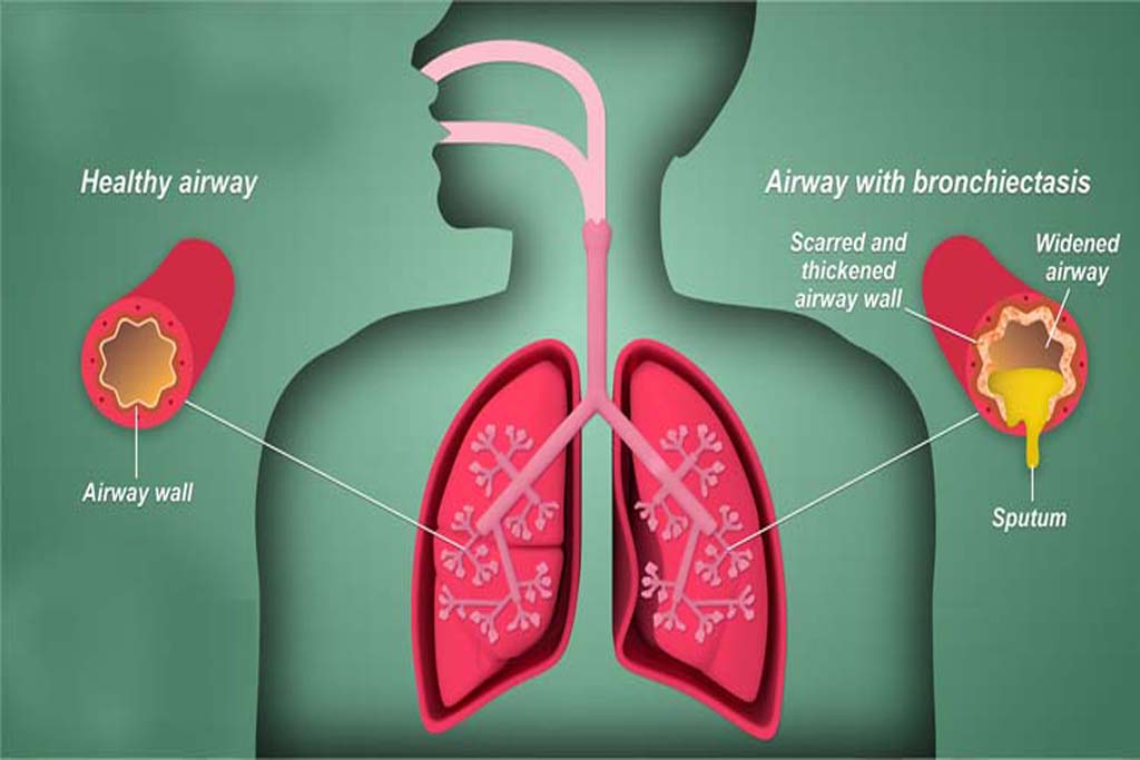 Pneumonia